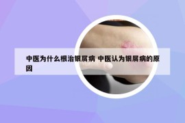 中医为什么根治银屑病 中医认为银屑病的原因