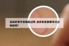 当兵的有牛皮癣能过吗 当兵有皮肤癣可以过体检吗?