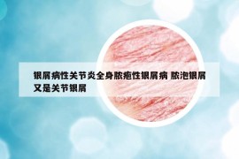 银屑病性关节炎全身脓疱性银屑病 脓泡银屑又是关节银屑