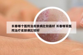 长春哪个医院治皮肤病比较最好 长春哪家医院治疗皮肤病比较好