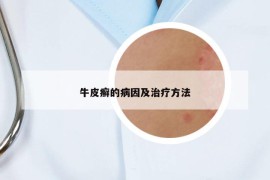 牛皮癣的病因及治疗方法