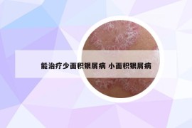 能治疗少面积银屑病 小面积银屑病