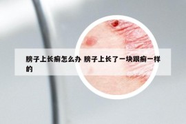 膀子上长癣怎么办 膀子上长了一块跟癣一样的