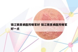 镇江银屑病医院哪家好 镇江银屑病医院哪家好一点