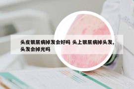 头皮银屑病掉发会好吗 头上银屑病掉头发,头发会掉光吗