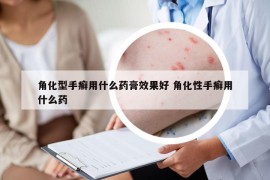 角化型手癣用什么药膏效果好 角化性手癣用什么药