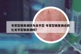 寻常型银屑病转为关节型 寻常型银屑病会转化关节型银屑病吗?