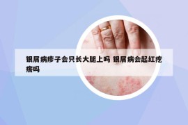 银屑病疹子会只长大腿上吗 银屑病会起红疙瘩吗