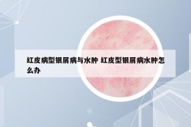 红皮病型银屑病与水肿 红皮型银屑病水肿怎么办