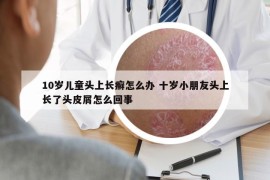 10岁儿童头上长癣怎么办 十岁小朋友头上长了头皮屑怎么回事