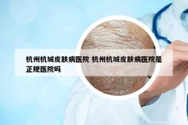 杭州杭城皮肤病医院 杭州杭城皮肤病医院是正规医院吗