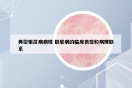 典型银屑病病理 银屑病的临床表现和病理联系