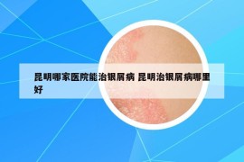 昆明哪家医院能治银屑病 昆明治银屑病哪里好