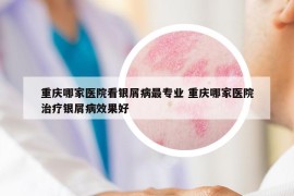 重庆哪家医院看银屑病最专业 重庆哪家医院治疗银屑病效果好