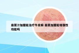 韭菜汁加醋能治疗牛皮癣 韭菜加醋能增强性功能吗