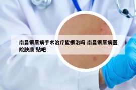 南昌银屑病手术治疗能根治吗 南昌银屑病医院肤康 贴吧