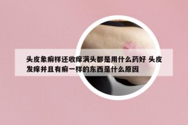 头皮象癣样还收痒满头都是用什么药好 头皮发痒并且有癣一样的东西是什么原因