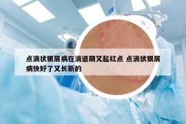 点滴状银屑病在消退期又起红点 点滴状银屑病快好了又长新的