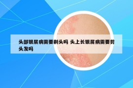 头部银屑病需要剃头吗 头上长银屑病需要剪头发吗