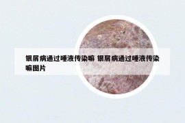 银屑病通过唾液传染嘛 银屑病通过唾液传染嘛图片