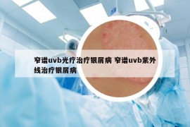 窄谱uvb光疗治疗银屑病 窄谱uvb紫外线治疗银屑病