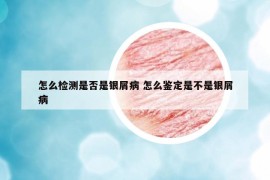 怎么检测是否是银屑病 怎么鉴定是不是银屑病