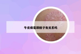 牛皮癣是跟精子有关系吗