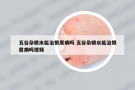 五谷杂粮水能治银屑病吗 五谷杂粮水能治银屑病吗视频