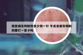 银屑病生物制剂多少钱一针 牛皮皮癣生物制剂要打一辈子吗