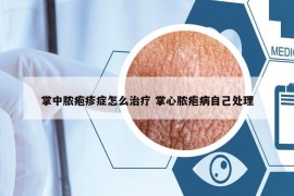 掌中脓疱疹症怎么治疗 掌心脓疱病自己处理