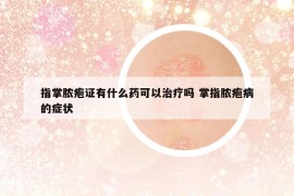 指掌脓疱证有什么药可以治疗吗 掌指脓疱病的症状