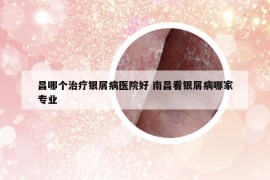 昌哪个治疗银屑病医院好 南昌看银屑病哪家专业