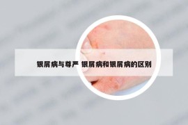 银屑病与尊严 银屑病和银屑病的区别