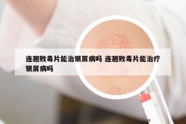 连翘败毒片能治银屑病吗 连翘败毒片能治疗银屑病吗