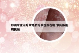 郑州专业治疗掌跖脓疱病医院在哪 掌跖脓疱病视频