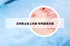 怎样防止身上长癣 如何避免长藓