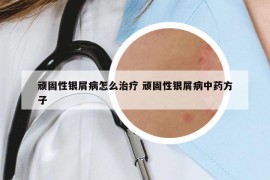 顽固性银屑病怎么治疗 顽固性银屑病中药方子