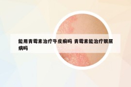 能用青霉素治疗牛皮癣吗 青霉素能治疗银屑病吗