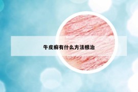 牛皮癣有什么方法根治