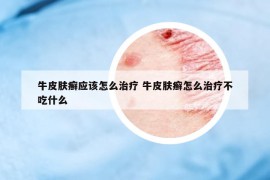 牛皮肤癣应该怎么治疗 牛皮肤癣怎么治疗不吃什么