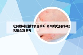 吃阿维a能治好银屑病吗 银屑病吃阿维a胶囊还会复发吗