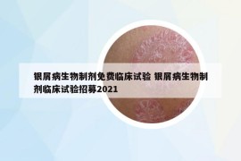 银屑病生物制剂免费临床试验 银屑病生物制剂临床试验招募2021