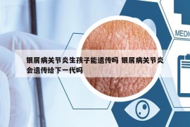 银屑病关节炎生孩子能遗传吗 银屑病关节炎会遗传给下一代吗