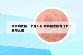 银屑病皮损一个月不好 银屑病皮损为什么下去那么慢