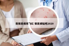 类银屑病周飞红 银屑病贴吧2020