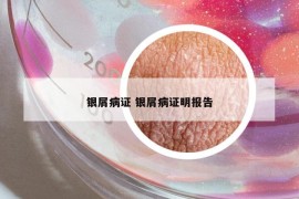 银屑病证 银屑病证明报告