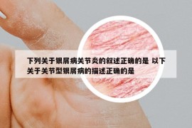 下列关于银屑病关节炎的叙述正确的是 以下关于关节型银屑病的描述正确的是