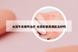 水滴牛皮癣咋治疗 水滴形银屑病能治好吗