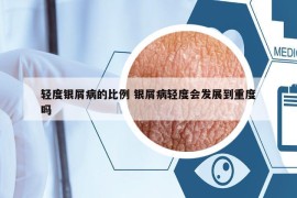 轻度银屑病的比例 银屑病轻度会发展到重度吗