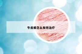 牛皮癣怎么有效治疗